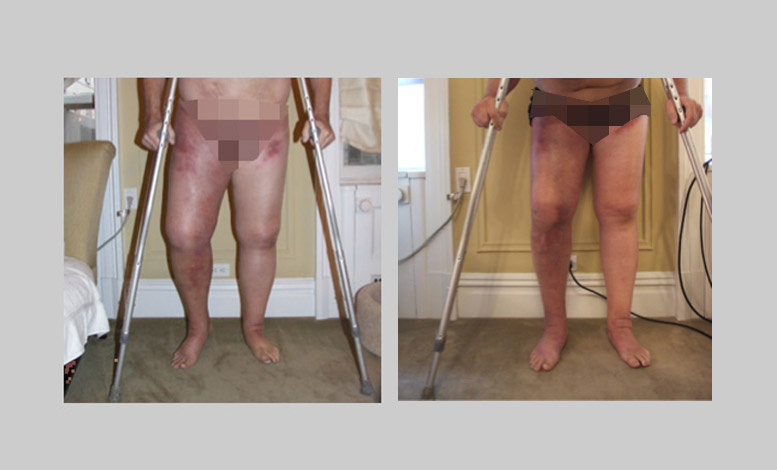 Lymphedema reults after 5 days of treatment