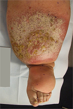 lymphedema treatment after limb before maintenance
